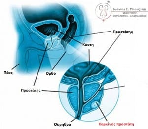 prostate-cancer bouzalas urology