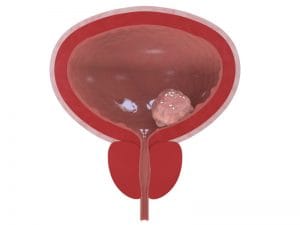 bladder_cancer_bouzalas urology